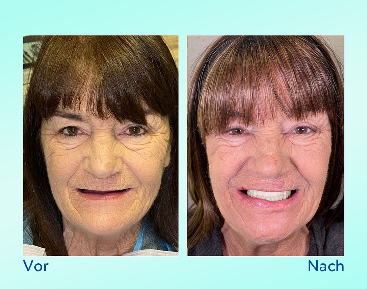 𝐁𝐢𝐤𝐞𝐧𝐝𝐚®🍀 --🦷 𝐌𝐚ß𝐠𝐞𝐟𝐞𝐫𝐭𝐢𝐠𝐭𝐞𝐬 𝐏𝐫𝐞𝐦𝐢𝐮𝐦-𝐕𝐨𝐥𝐥𝐩𝐫𝐨𝐭𝐡𝐞𝐬𝐞𝐧-𝐒𝐞𝐭 🦷 (⏰ 𝐍𝐮𝐫 𝐧𝐨𝐜𝐡 𝟑𝟎 𝐌𝐢𝐧𝐮𝐭𝐞𝐧 𝐥𝐢𝐦𝐢𝐭𝐢𝐞𝐫𝐭𝐞𝐬 𝐀𝐧𝐠𝐞𝐛𝐨𝐭! ⏰)